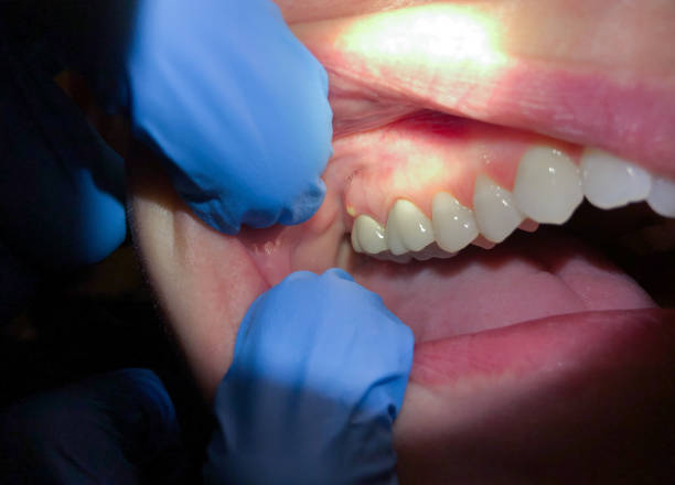 Best Emergency Root Canal Treatment in Saxapahaw, NC