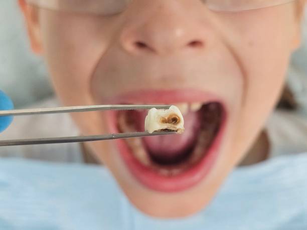 Best Emergency Tooth Extraction in Saxapahaw, NC